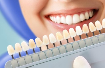 Teeth Whitening